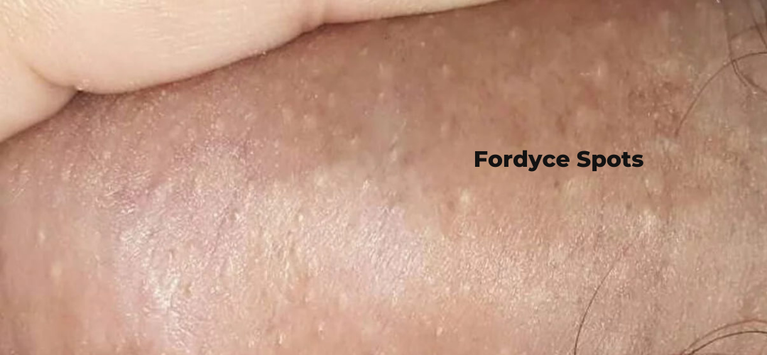 Manchas de Fordyce na haste do p-nis — pequenas bolinhas claras amareladas, variação anatômica normal, não DST